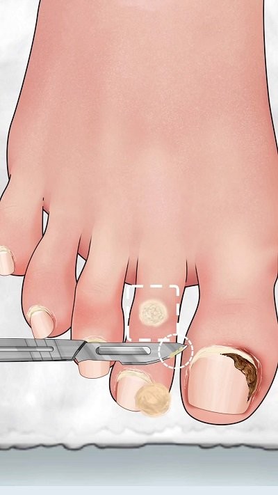 沉浸式修脚大师(1)